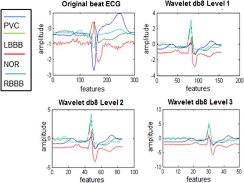 The ECG decomposed signal.