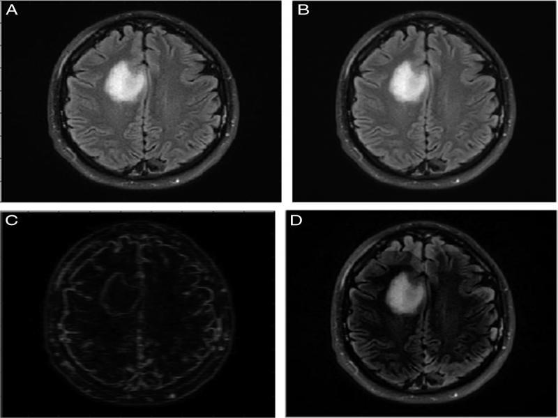 Pre-processing phase 1. (A) Grayscale image, (B) Image after median filter, (C) Image after smoothening, (D) Image after top-hat filter.