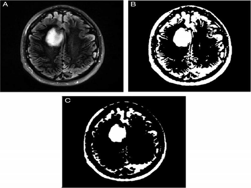 Pre-processing phase 2. (A) Contrast enhancement, (B) Image after binarization, (C) Image after morphological erosion.