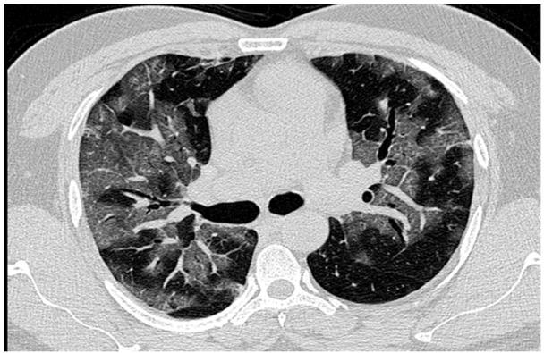 An axial section of the high resolution computed tomography chest image in a lung window showing patchy diffuse ground glass density s/o acute interstitial pneumonia.