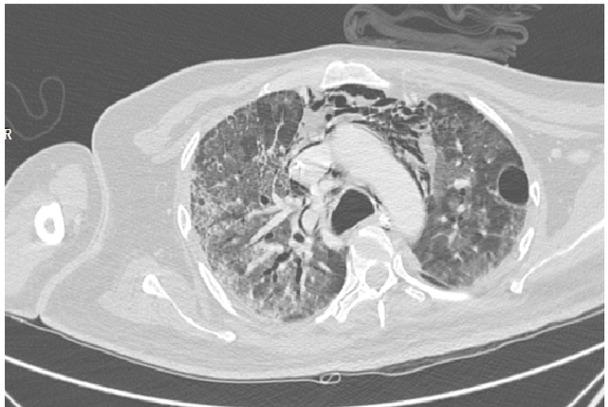 An axial section of the high resolution computed tomography chest image in a lung window showing Mediastinal emphysema (pneumomediastinum)