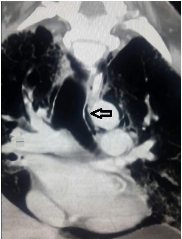 A coronal plane CT thorax showing extensive pneumomediastinum with peribronchial air (arrow) demonstrating the Macklin effect. Also we can see the continuous diaphragmatic sign.