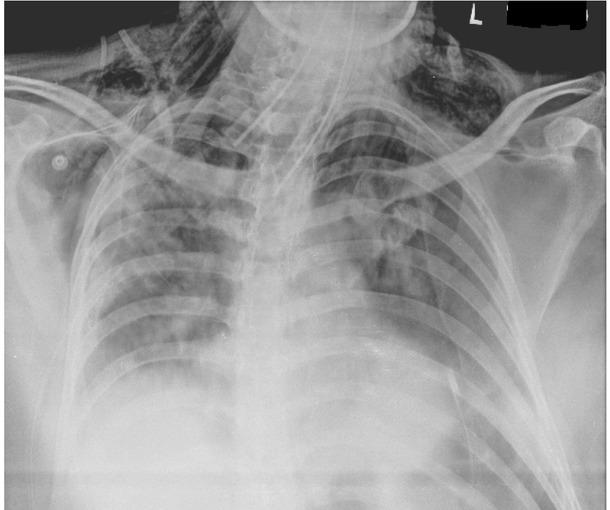 Chest xray showing extensive subcutaneous emphysema under both shoulders and pneumomediastinum.