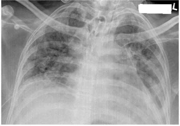 Complete resolution of above changes post bilateral intercostal drains.