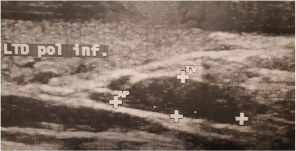 Cervical ultrasonography indicating an hypoechogenic mass, corresponding to the right inferior parathyroid adenoma.