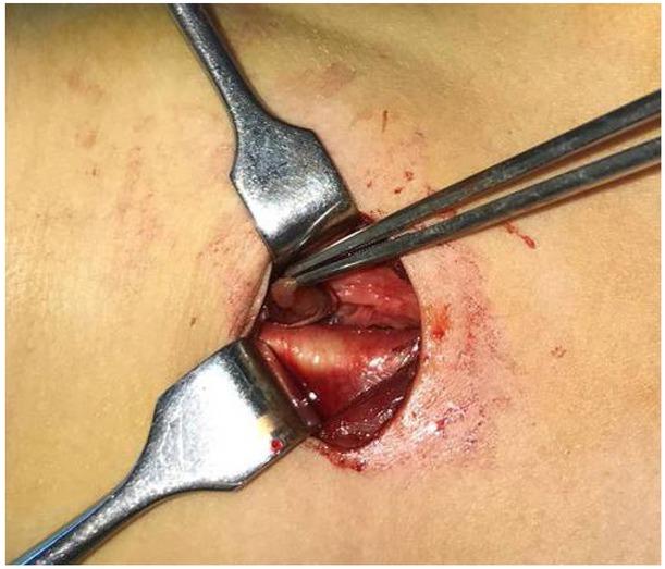 Right open minimally invasive parathyroidectomy (OMIP)- the right inferior parathyroid adenoma.