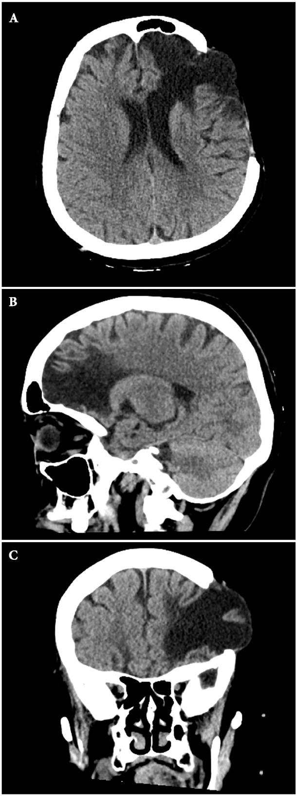 CT scan of the brain in transverse (A), sagittal (B) and coronal (C) planes.