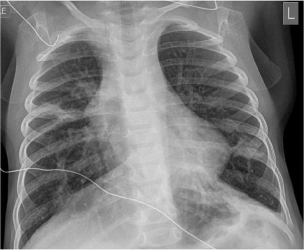 Chest radiograph on admission. The image shows pulmonary hyperexpansion with interstitial prominence and areas of patchy density which may be due to a viral airway disease with areas of atelectasis.