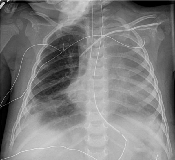 Chest radiograph on hospital day 13. The image shows generalized opacification of the left hemithorax with no mediastinal shift. This could represent a combination of pleural fluid and atelectasis. Persistent right lower lobe atelectasis is seen along with right pleural fluid.