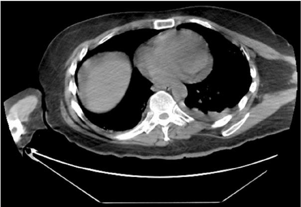 C.T. Scan: Abdomen and Pelvis without contrast on Day 21 of admission.