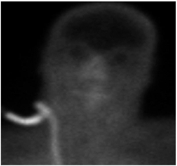 Brain perfusion scan demonstrating no discernible uptake by the brain.