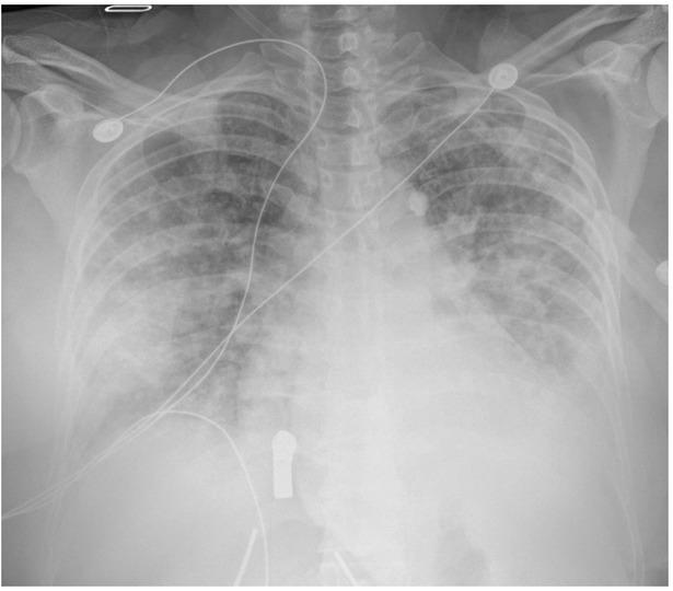 Chest X-Ray (Single View) on Day 3 of Hospitalization