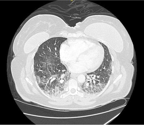 Chest CT Angiography on Day 2 Of Hospitalization