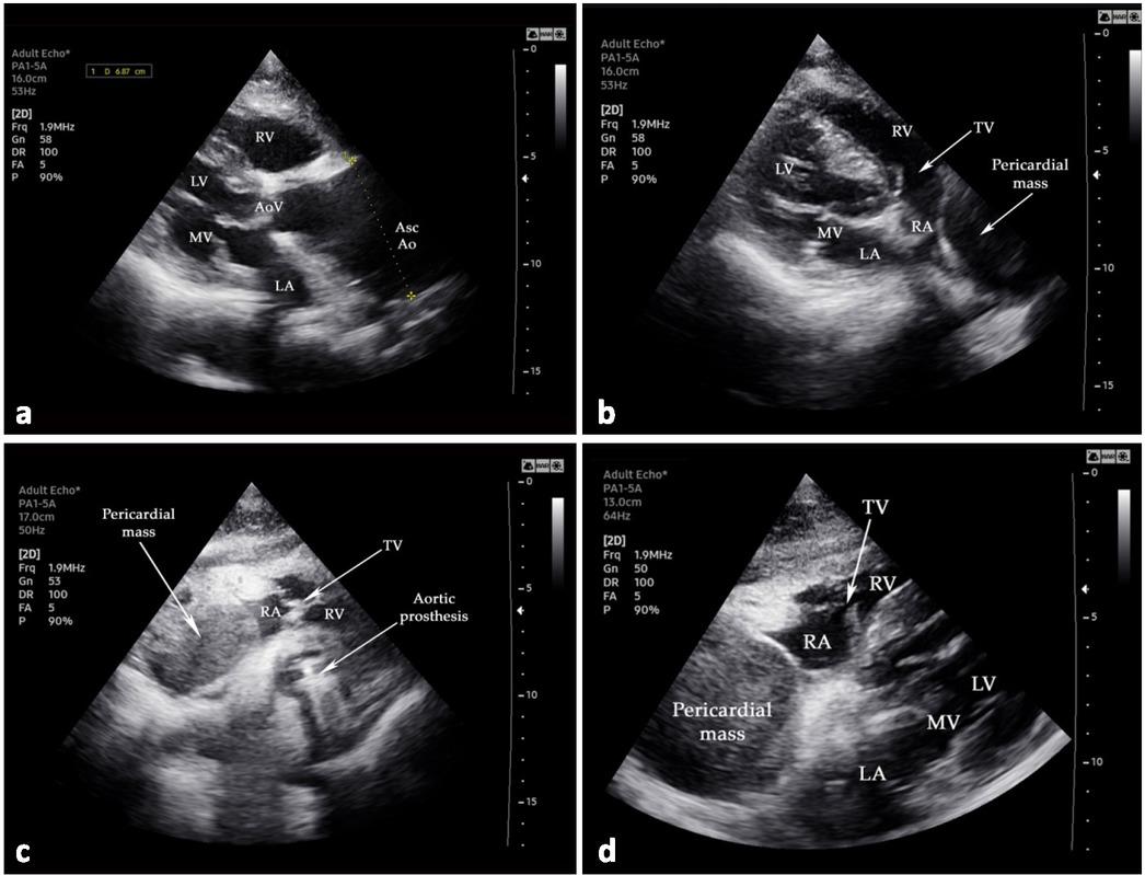 Transthoracic echocardiography examination: (a) the clear presence of the ascending aortic aneurysm (6.87 cm); (b–d) massive pericardial tumoral mass compressing the right atrium. Abbreviations: LA—left atrium; LV—left ventricle; MV—mitral valve; RA—right atrium; RV—right ventricle; SVC—superior vena cava; TV—tricuspid valve; AoV — aortic valve; AscAo — ascending aorta.