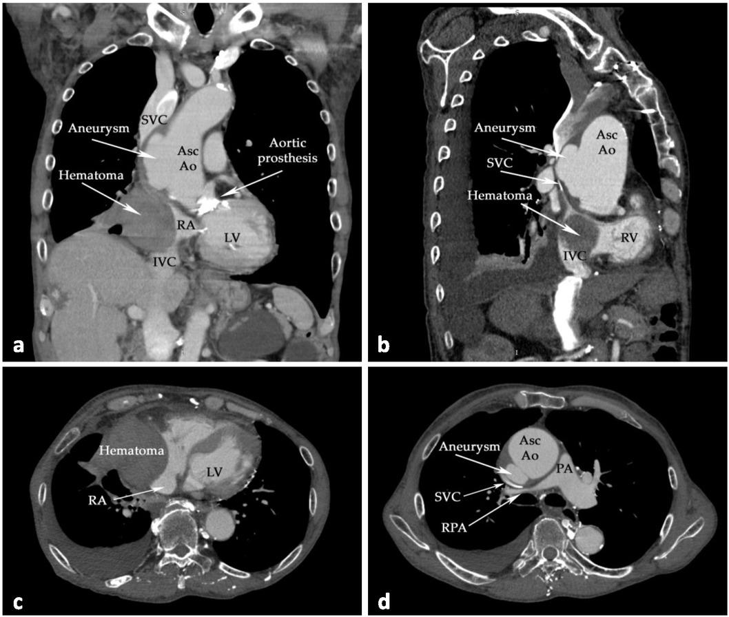 Emblematic thoraco-abdominal CT scans. In the coronal and sagittal scans ((a) and (b), respectively), the presence of an ascending aortic aneurysm, hematoma, and compression on RA, SVC, and IVC can be observed. (c) Compression of RA; (d) compression of SVC and RPA (axial CCTA scans). Abbreviations: AscAo—ascending aorta; IVC—inferior vena cava; LV—left ventricle; PA—main pulmonary artery; RA—right atrium; RPA—right pulmonary artery; SVC—superior vena cava.