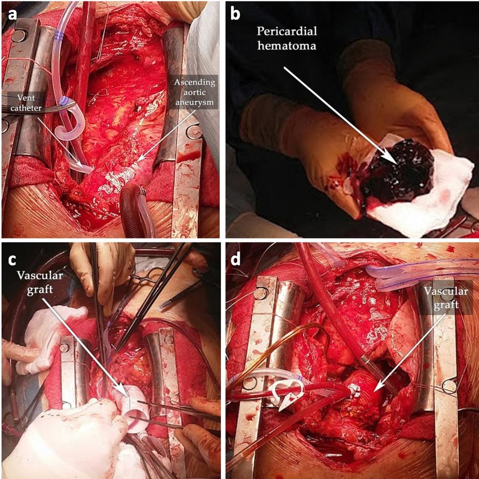 Intraoperative images. (a) Post-sternotomy, the ascending aortic aneurysm was revealed; (b) the chronic pericardial hematoma; (c) the ascending aorta replaced with a 30 mm-diameter vascular graft; (d) the final result.