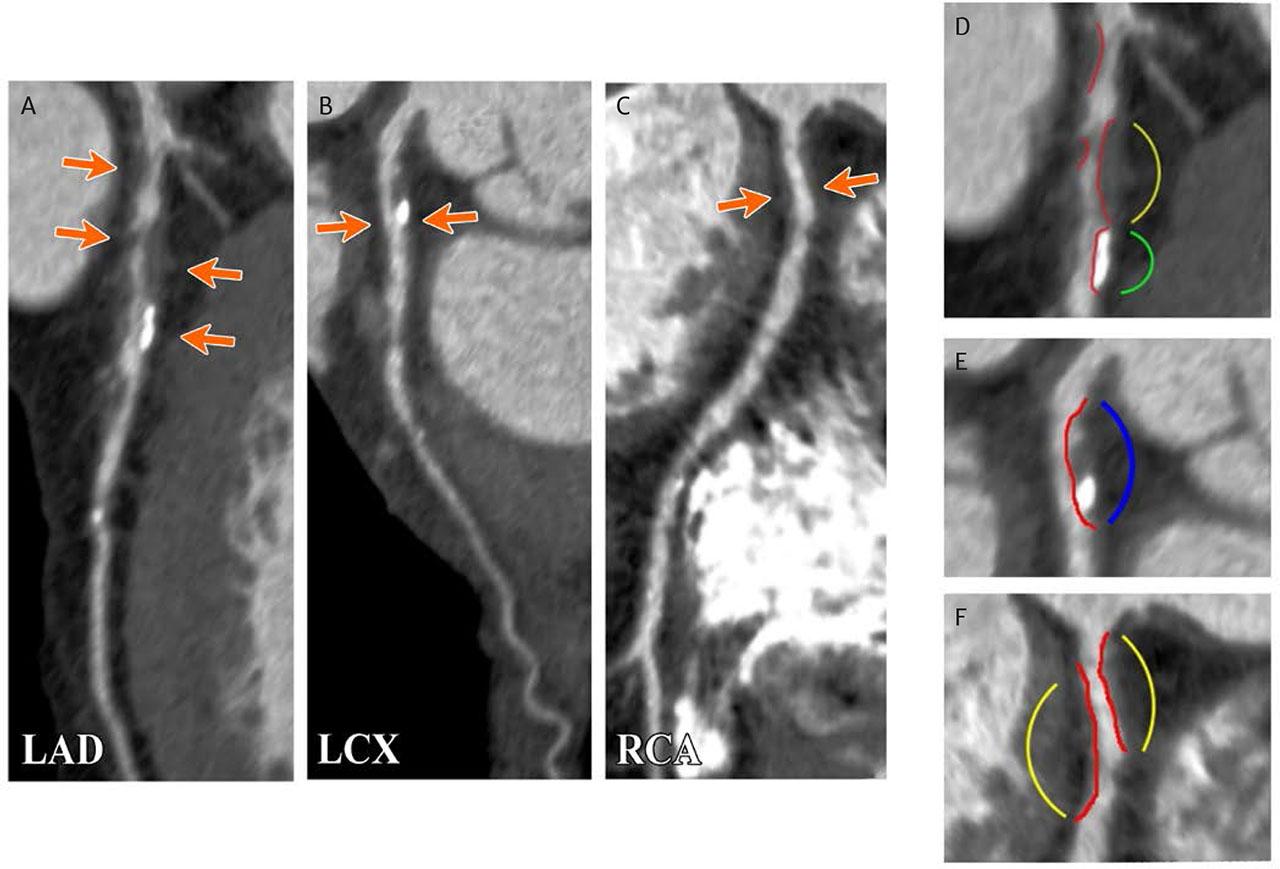 CCTA reconstruction of the LAD (A), LCX (B), and RCA (C). D – area from A; E – area from B; F – area from C. Orange arrows, coronary plaques; red lines, the arterial lumen; yellow lines, noncalcified plaque; blue lines, plaque with both calcified and non-calcified contents; green lines, a highly calcified plaque.