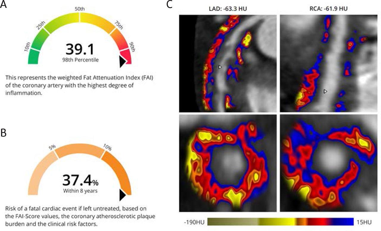 Inflammation analysis. A – FAI score, representing the weighted FAI of the coronary artery with the highest degree of inflammation; B – CaRi-Heart risk, the risk of a fatal cardiac event if left untreated, based on the FAI score values, the coronary atherosclerotic plaque burden, and the clinical risk factors, showing a high risk for cardiac events; C – Inflammation mapping of LAD and RCA, with hues toward blues reprezenting a higher degree of inflammation