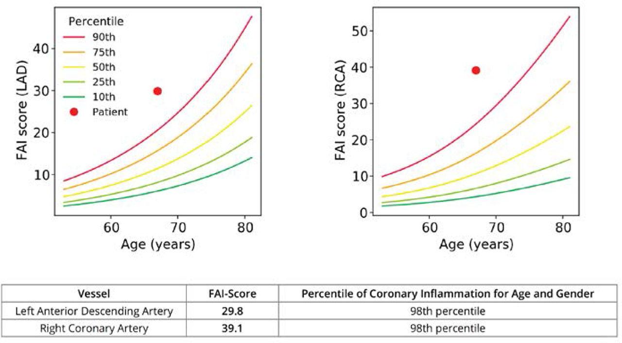 FAI score percentile placing the patient in the 98th percentile for inflammation adjusted for age and gender