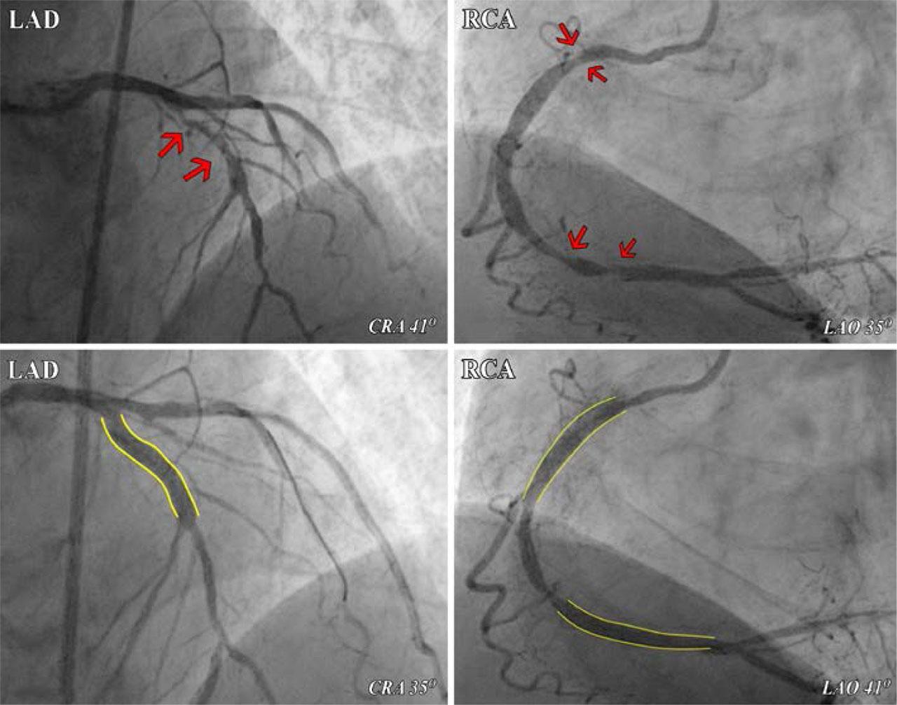 Coronary angiography showing severe vascular disease. Red arrows, coronary stenoses on LAD and RCA; yellow lines, sites of stent implantation with minimal residual stenoses