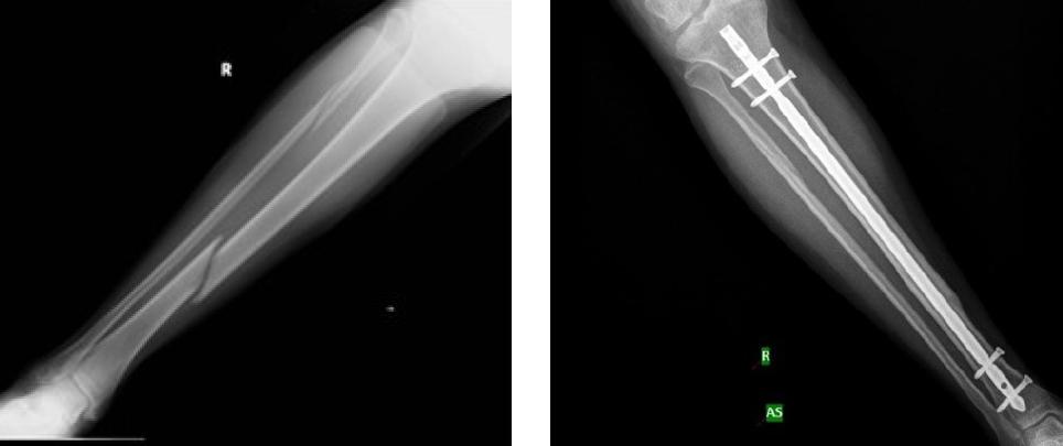 X-rays of right leg (A/P) lateral view, showing closed tibia-fibula (transverse) shaft fracture (left) and interlocking nail post-surgery (right)