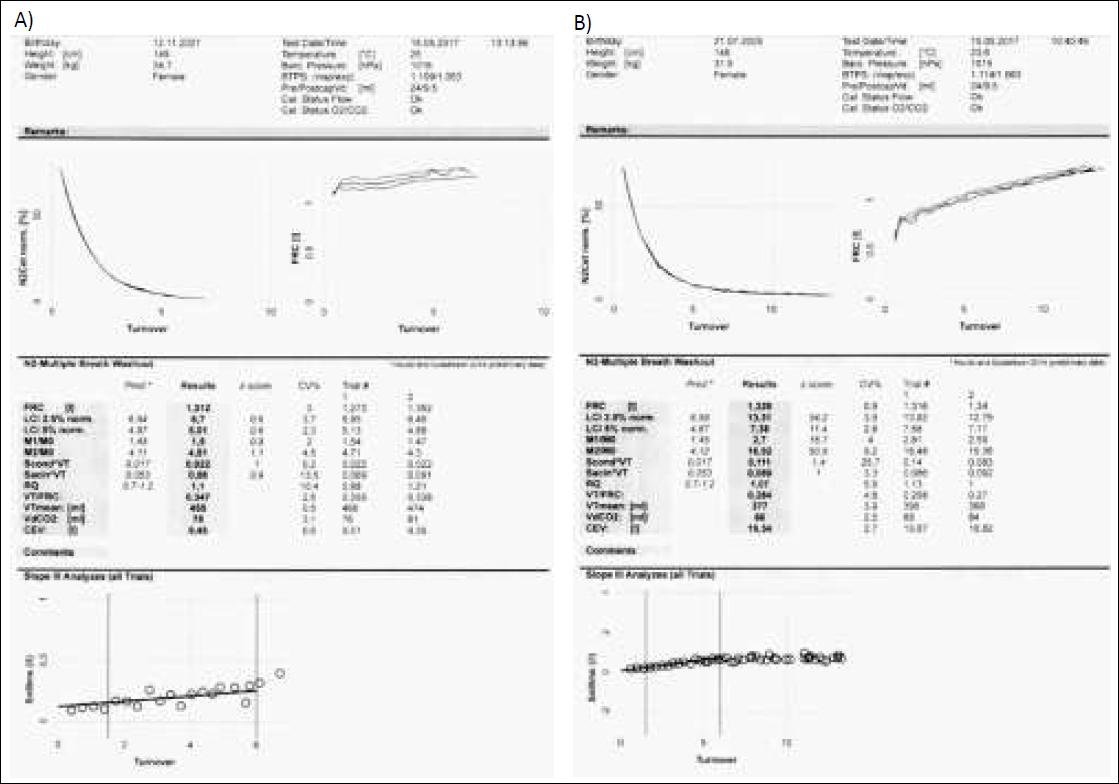 Wyniki badania MBNW chorych na mukowiscydozę: A) wynik w normie B) podwyższony wskaźnik LCI.
Fig. 5. Test results MBNW in CF patients: A) result in the standard B) increased LCI.