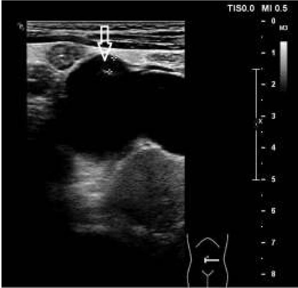 Badanie USG – widoczne wodonercze lewego układu i wysokie odejście lewego moczowodu.
Fig. 1. Ultrasonography images of left collecting system hydronephrosis and high insertion of the left ureter.