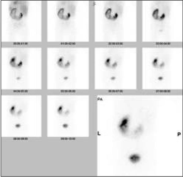 Scyntygrafia dynamiczna nerek z użyciem 99mTc-EC nerki podkowiastej z wodonerczem lewostronnym, z objawami częściowo utrudnionego wydalania na poziomie ujścia miedniczkowo-moczowodowego.
Fig. 2. Dynamic scintigraphy with 99mTc-EC of horseshoe kidney with hydronephrosis of the left-sided pelvicalyceal system and partial obstruction at the level of the uretropelvic junction.