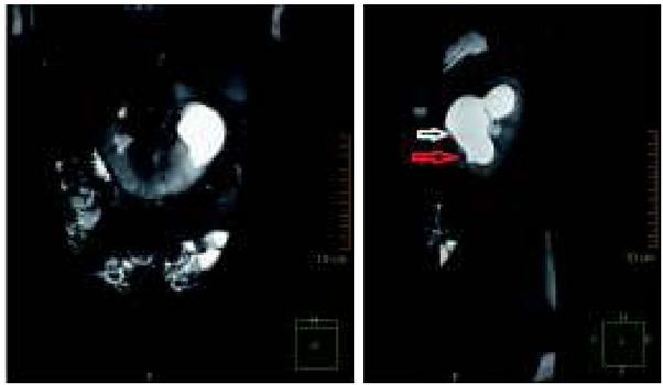 T2-zależne rekonstrukcje czołowa i strzałkowa urografii rezonansu magnetycznego nerki podkowiastej, z wodonerczem lewego układu i wysokim odejściem lewego moczowodu; biała strzałka – odejście moczowodu, czerwona strzałka – moczowód.
Fig. 3. Coronal and sagittal T2-weighted magnetic resonance urography images of horseshoe kidney, with hydronephrosis of the left collecting system and high insertion of the ureter.
