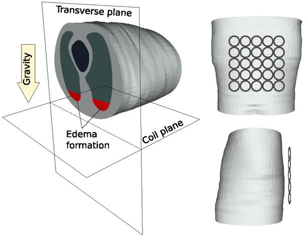 The realistic chest model and the coil arranegement used in simulations. Red regions within the lungs represent the fluid accumulation, i.e., edema formation regions, due to gravity.