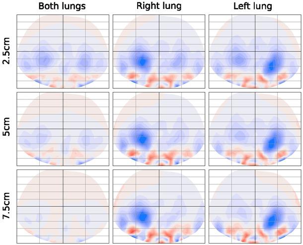The left column shows the lung function with different levels of lung collapse occured in both lungs simultaneously. The middle and right columns represent, respectively, the cases that the collapse occured in the left lung and right lung only. The rows denote different levels of lung injury.