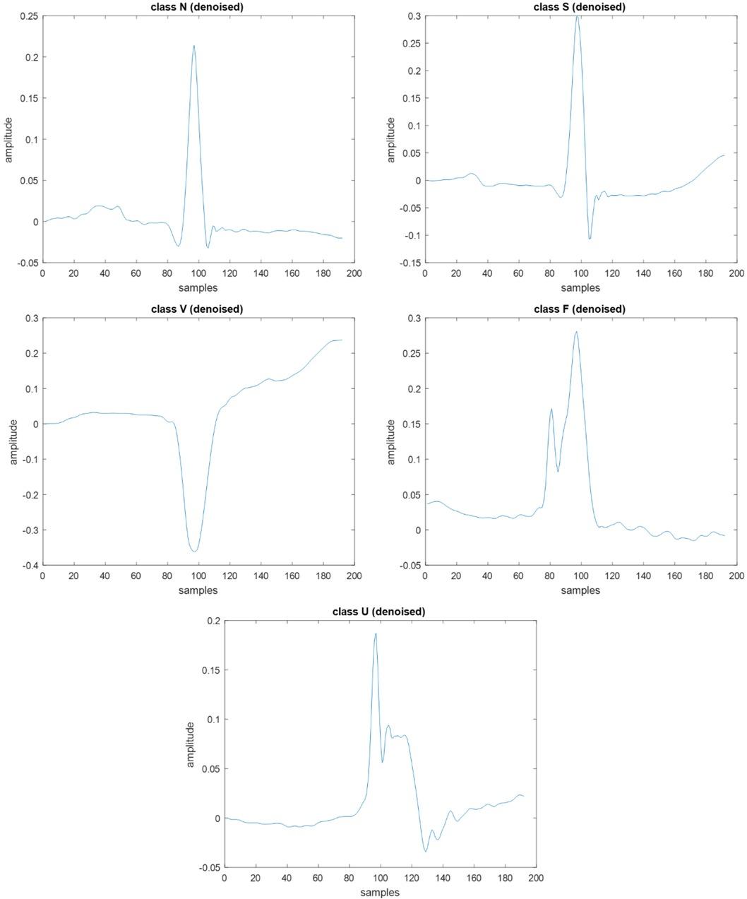 Example of five different categories of heartbeats that are denoised and segmented.