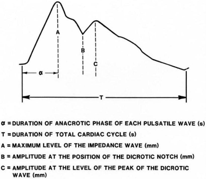 Graphical technique used to analyze the IPG waveform.