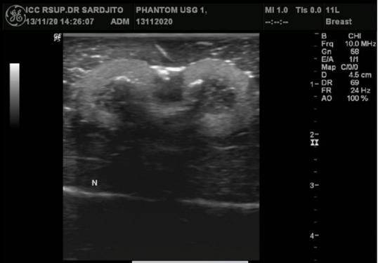 Ultrasound images of two artificial solid tumors made of olive and carrot pieces to represent oval inhomogeneous lesions. Olive flesh appeared as a mildly hyperechoic area at the edge of the lesion, while carrot pieces appeared as a hypoechoic area in the middle portion with a posterior shadow and several small linear hyperechoic areas.