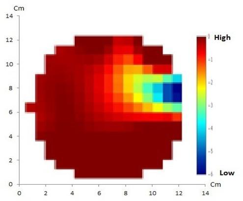 GREIT method with 16 electrodes of artificial solid tumor shows discordance between the reconstructed image and the original object in which only one anomaly is displayed instead of two.