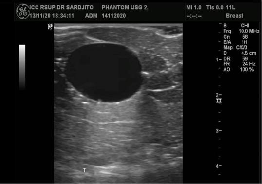 A water-filled balloon was used to mimic a cystic lesion. This ultrasound image demonstrated the cystic lesion as a well-defined, oval-shaped anechoic area with posterior enhancement.