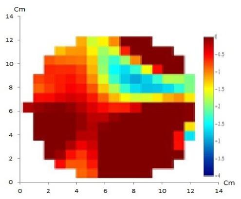 GREIT method with 16 electrodes of artificial cystic tumor has shown a match between the reconstructed image and the original object containing one anomaly.