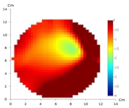 GREIT method with 32 electrodes of artificial cystic tumor showed a match between the reconstructed image and the original object containing one anomaly that shows clear oval with smooth borders resembling the real cystic tumor.