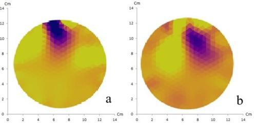 NOSER method with 16 (a) and 32 electrodes (b) of artificial cystic tumor shows a match between the reconstructed image and the original object containing one anomaly.