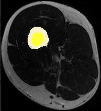 Slice 12 of segmented bone and bone marrow. Note that it may be difficult to see that the colours of bone and bone marrow are different in grayscale prints.