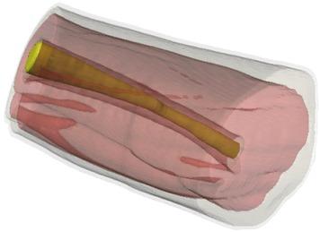 3D-view of thigh after filtering.