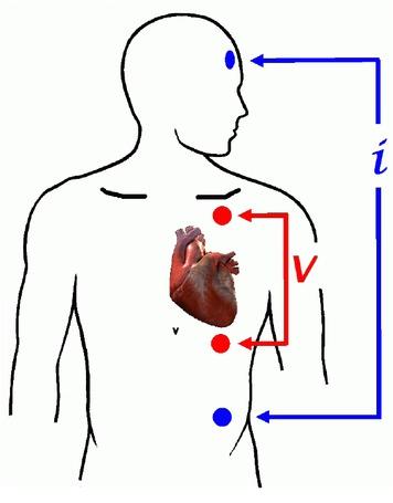 Electrode configuration for the measurement of ISTI: A small electrical current i was applied to the upper part of the body by means of the two outer electrodes. The two inner electrodes measured the subsequent electrical voltage difference V over the heart from which the impedance Z was computed.