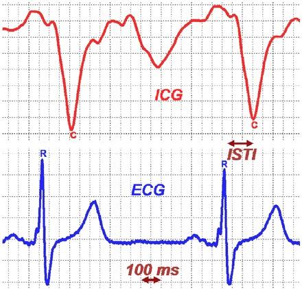 Simultaneous registration of an Impedance CardioGram (ICG) and an ElectroCardioGram (ECG) (arbitrary units). ISTI is defined as the time interval between the R-point in the ECG and the C-point in the ICG.