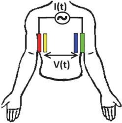 Electrode placement for trans-thoracic bioimpedance measurements: two electrodes (red and green) are used for the application of an excitation current (I(t)), and two electrodes for the measurement of the voltage drop (V(t)).