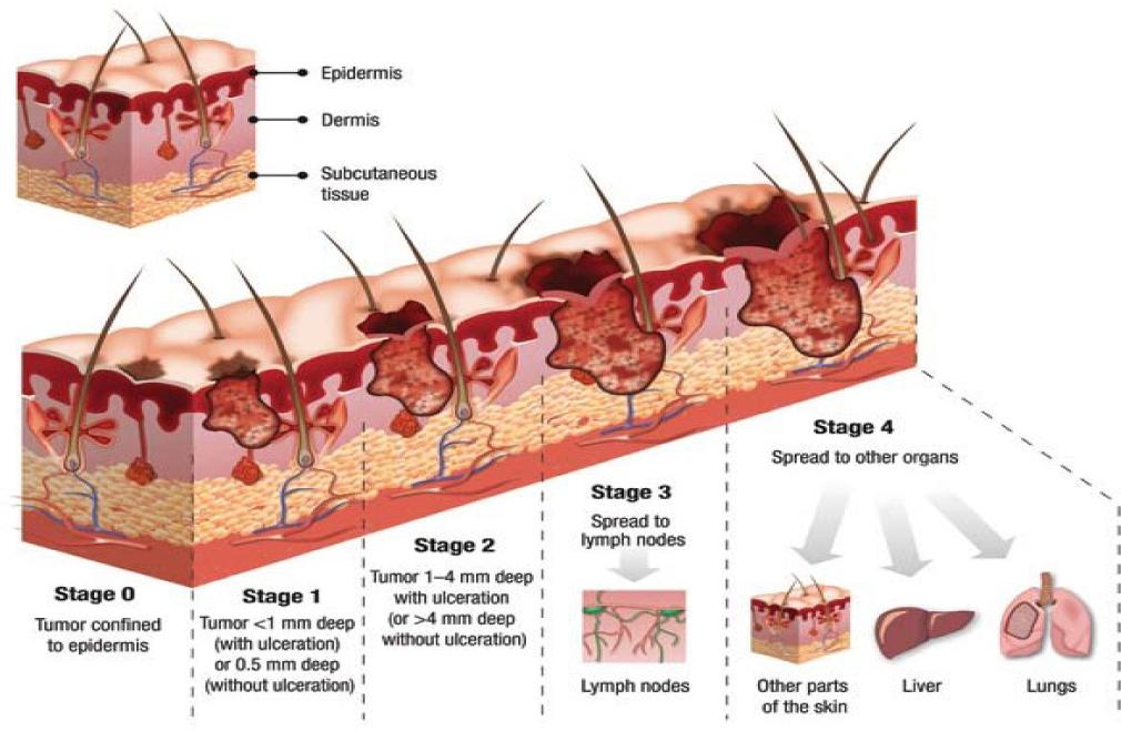 Skin cancer stages (source: teleskin.org)