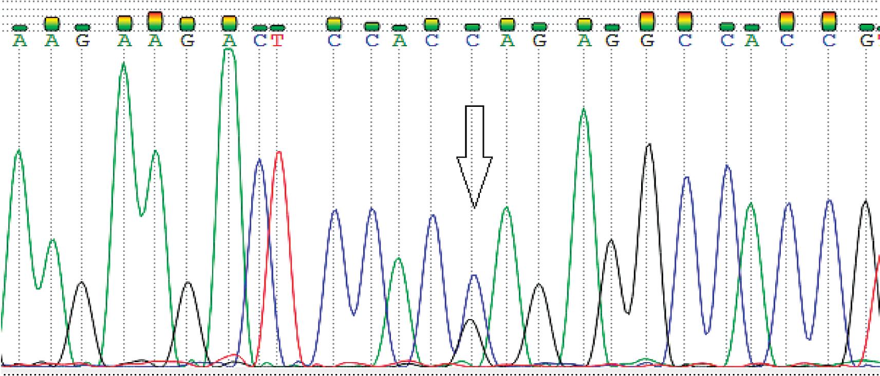 Molecular testing with Next Generation Sequencing technique revealed mutations a tRELN gene.