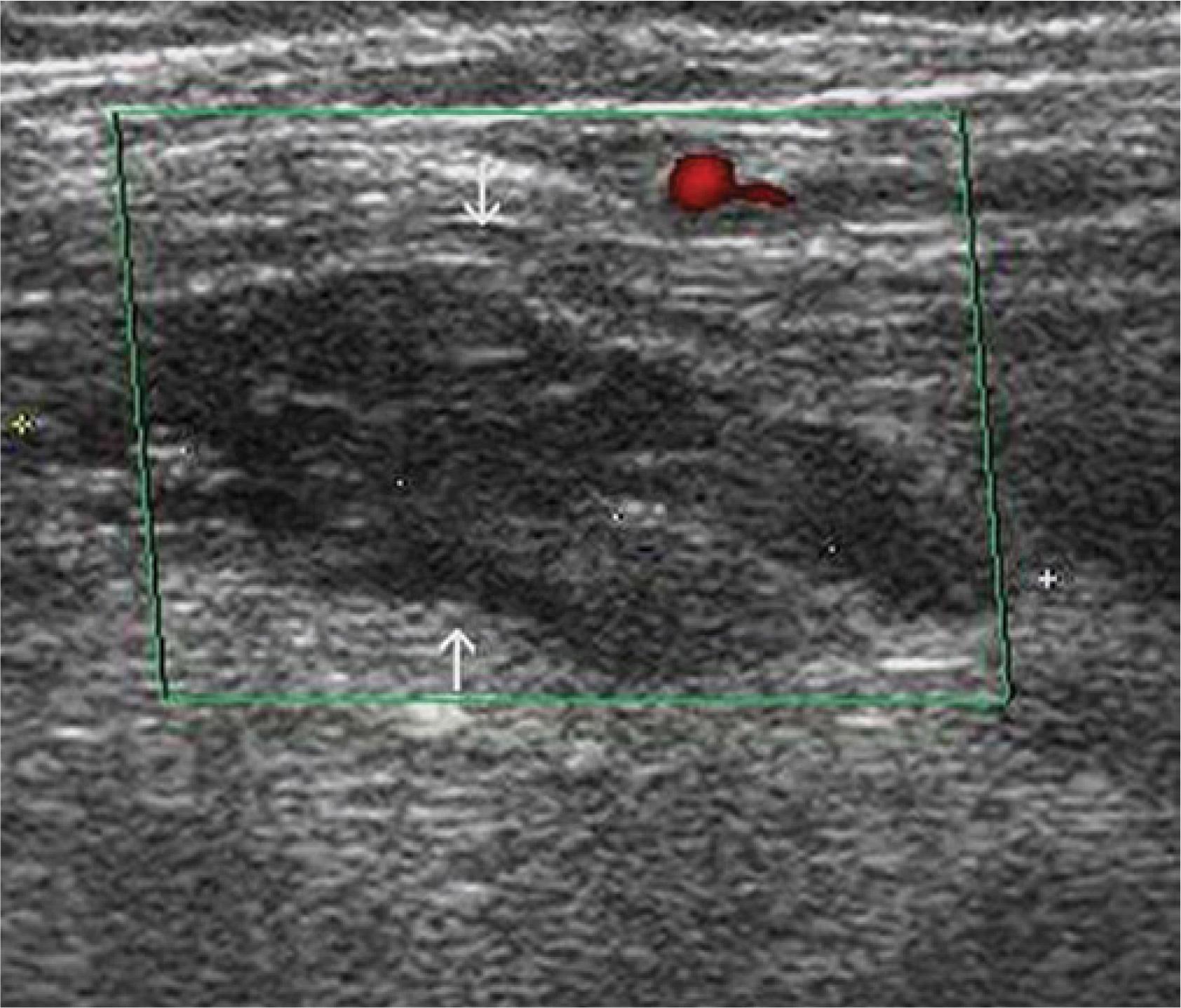 Cavernous angioma (arrows) in the dorsal chest