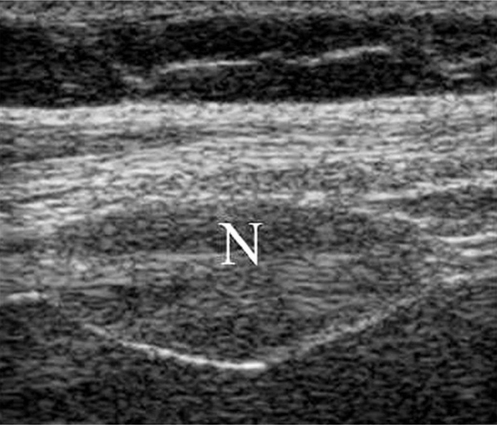 Neurofibroma (N) in the 10th intercostal space