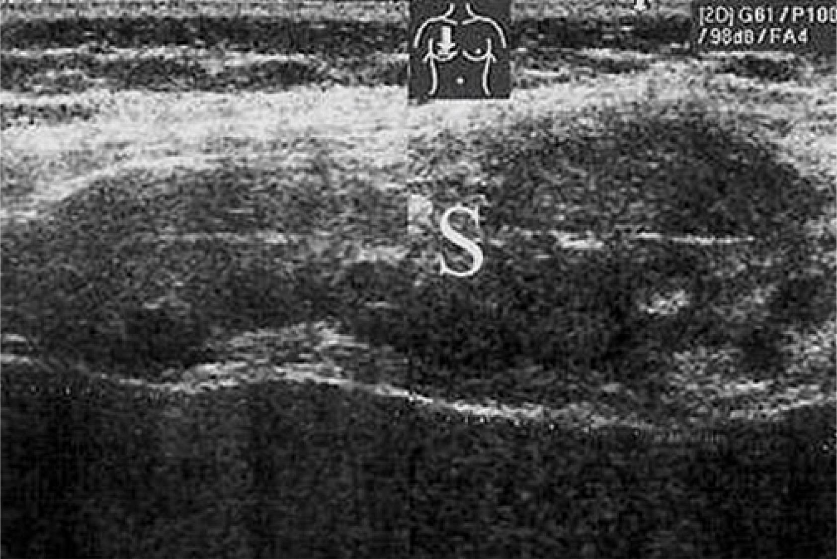 A large schwannoma (S) causing dilation of the 5th intercostal space