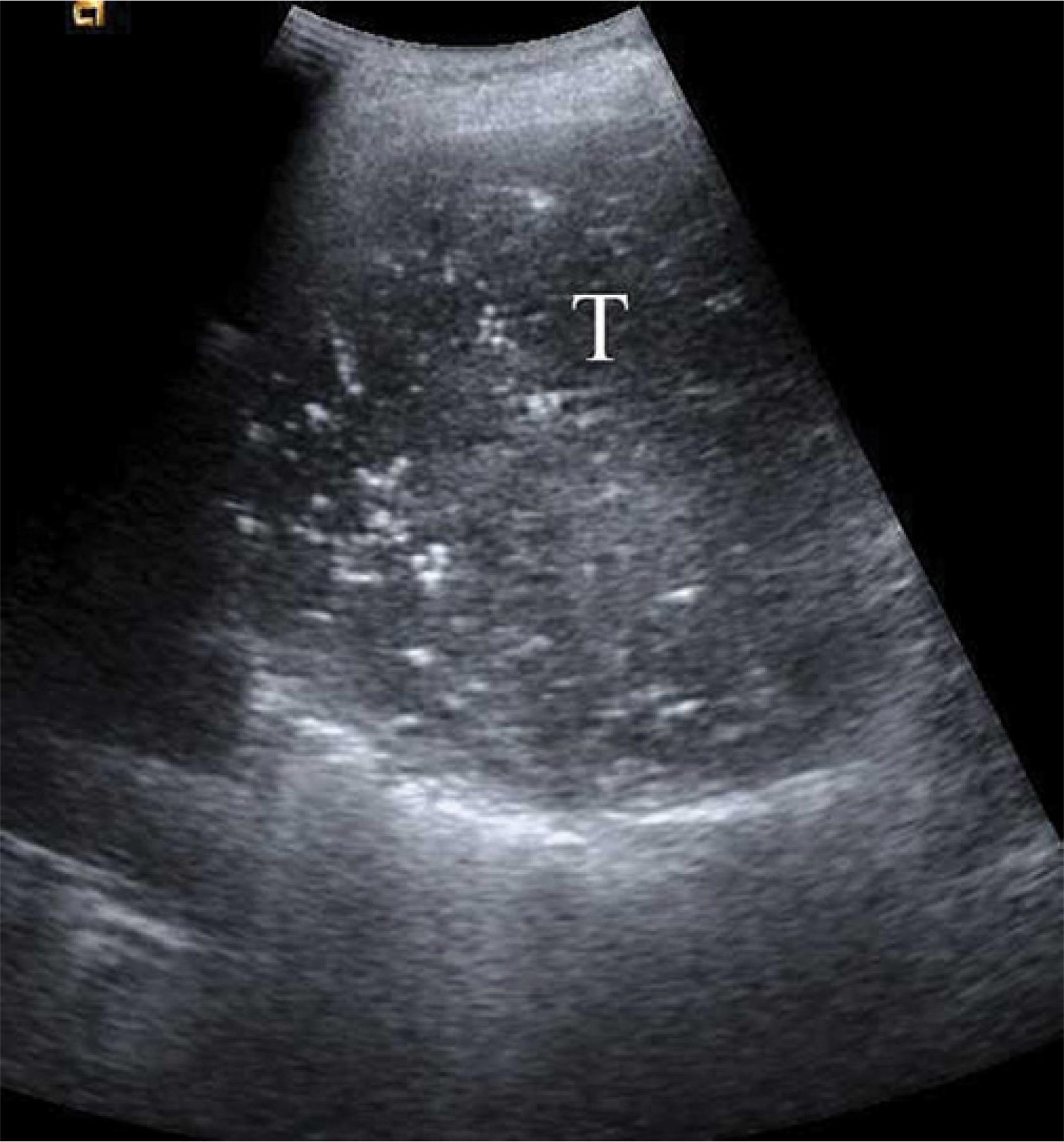 A giant neuroma in the posterior right mediastinum (T)
